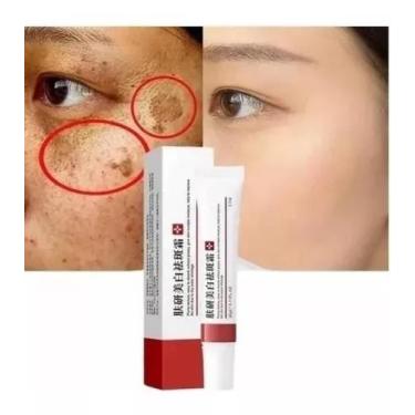 Imagem de Creme Facial Clareador Melasma Acne Sardas Manchas Escuras - Ebug