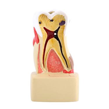 Imagem de Modelo de Cárie Dentária para Doença Dentária, Seção Transversal Patológica para Ensino de Dentista Escolar Com Nervo