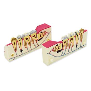 Imagem de Modelo de Dentes Dentários, Modelo de Dentes de Implante Dentário Transparente Modelo de Ensino Patológico de Dente Removível Padrão de Doença Padrão de Dentista (D-WD)