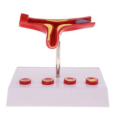 Imagem de Menolana Magnification 50x Very Detailed Section of The Atherosclerosis