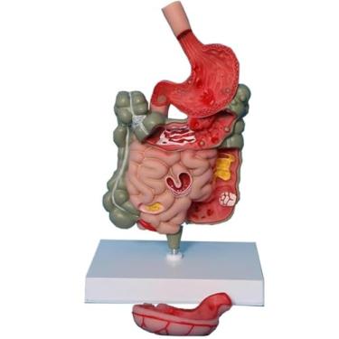 Imagem de Modelo de patologia do intestino grande, modelo de anatomia do estômago humano - modelo de sistema digestivo patológico, modelo de ensino removível, seção de estômago grande modelo médico de intestino