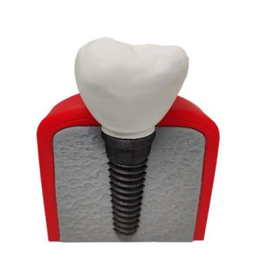 Imagem de Implante Dental Análise Modelo Dentário Dente 3D Anatomia - Pupa 3D