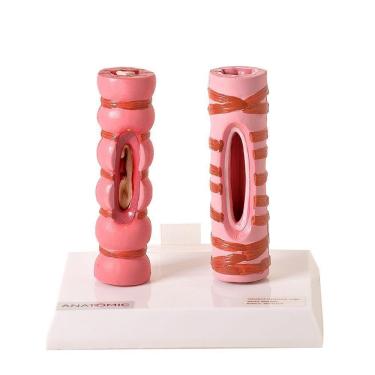 Imagem de Brônquio Saudável e Patológico Comparação