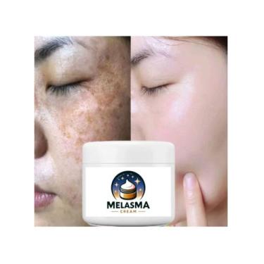 Imagem de Creme Pomada Para Tirar Manchas, Espinhas Melasma 30g. - Melasma Cream