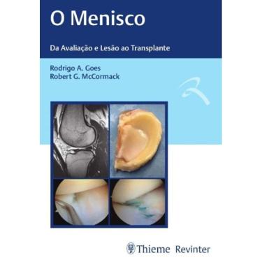 Imagem de o Menisco - Da Avaliação e Lesão Ao Transplante