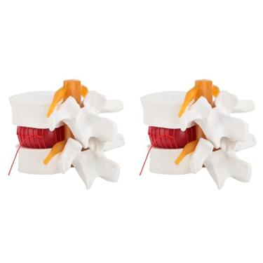 Imagem de Modelo de Hérnia de Disco Lombar Com Ampliação de 1,5 Vezes, Instrumento de Ensino de Cirurgia Ortopédica, Modelo de Demonstração de Coluna Humana Com Nervo para Ensino Clínico