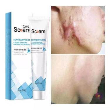 Imagem de Creme Gel Para Queloide Cicatriz Hipertrófico Pele Scoars 20g