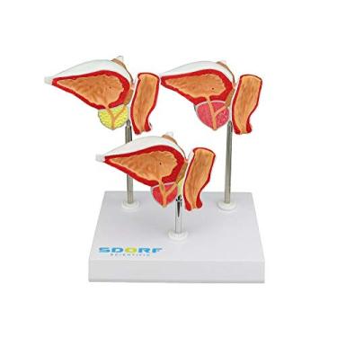 Imagem de Modelo Patológico da Próstata em 3 Fases