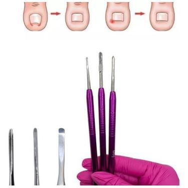 Imagem de 3 Bisturis Remoção Unha Encravada 207, 208 E 214 Original - Jon indúst