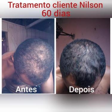 Imagem de Calvície e queda de cabelo  - Novo 