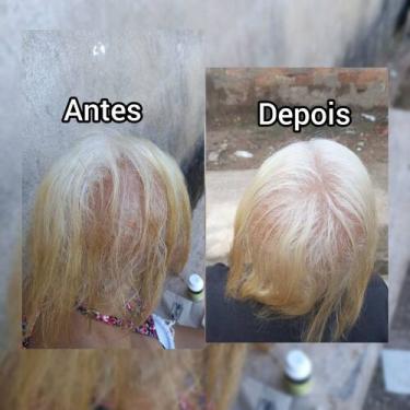 Imagem de Calvície e queda de cabelo  - Novo 
