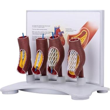 Imagem de Modelo de Stent Vascular Modelo Humano Coronário Vascular Modelo Anatômico Demonstração de Ampliação de Vaso Humano para Educação e Treinamento Médico