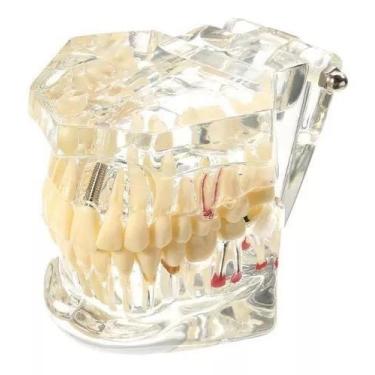 Imagem de Manequim Modelo Dentário Ortodontia Dente Implante - MHR