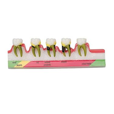Imagem de Modelo de Dente, Dentes Modelo de Doença Periodontal Diferentes Estágios Resina Periodontite Modelo de Exibição Cárie Dentária Modelos de Dente Ensino Ferramentas de Aprendizagem p