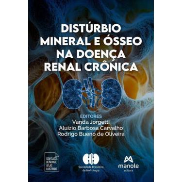 Imagem de Distúrbio Mineral E Ósseo Na Doença Renal Crônica - MANOLE, Sortido