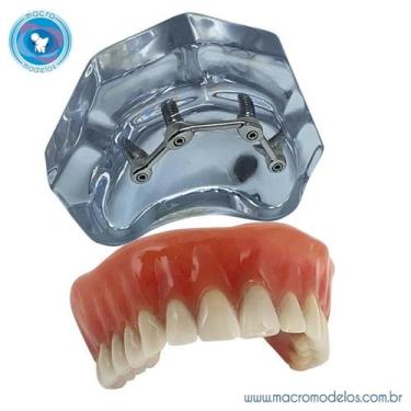 Imagem de Macro Modelo Overdenture em Acrílico com 4 implantes Barra Clip - Macr