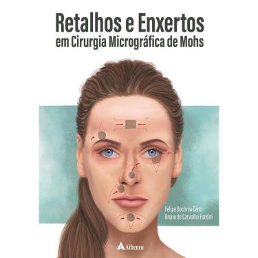 Imagem de Retalhos E Enxertos Em Cirurgia Micrografica De Mohs