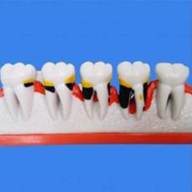Imagem de Macro Modelo Doença Periodontal com Furca e Bruxismo Sucesso - Macro M