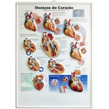 Imagem de Pôster 3D Doenças do Coração em Alto-Relevo. - LAUTZ
