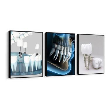 Imagem de Kit Quadros Decorativos De Odontologia Implante Dentista