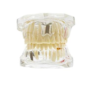 Imagem de Modelo de dentes de doença transparente, modelo de dentes de implante dentário transparente modelo de ensino patológico de dente removível padrão de dentista
