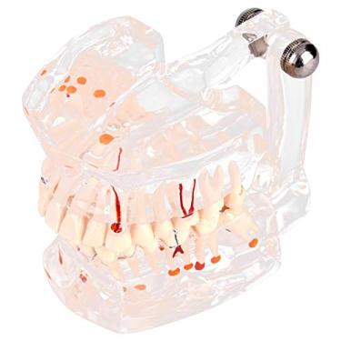 Imagem de modelo de cárie dentária transparente gengival com nervo dentário dentadura patológica modelo de dente ensino estudo demonstração doença educacional