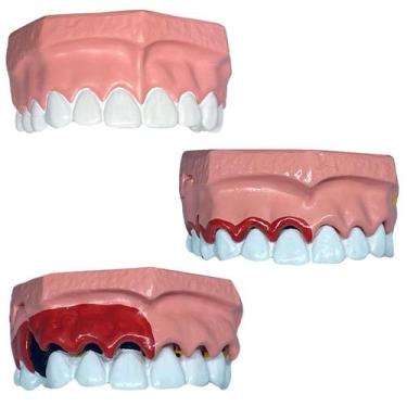 Imagem de Macro Modelo Evolução da Doença Periodontal - Macro Modelos