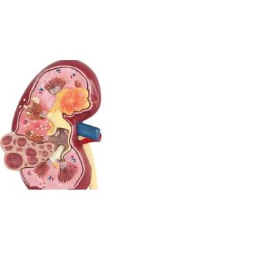 Imagem de Modelo Anatômico Rim Com Patologia Pedra Rins Urológico - KIDNEY DISSE