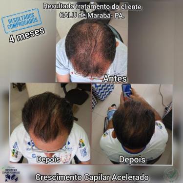 Imagem de Calvície e queda de cabelo  - Novo 