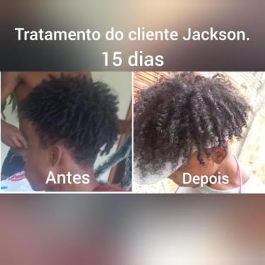Imagem de Calvície e queda de cabelo  - Novo 