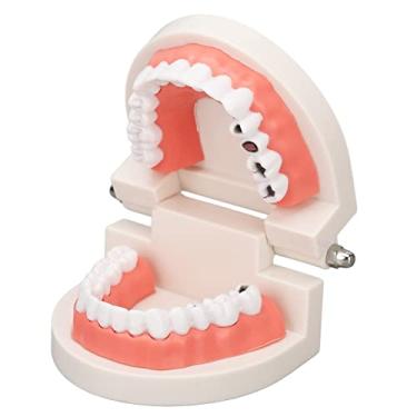 Imagem de Modelo de cárie dentária para doença dentária, suporte de ensino de simulação de resina, modelo de dentes dentários para educação de pacientes e estudantes