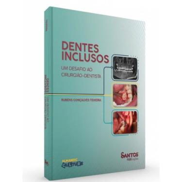 Imagem de Dentes Inclusos - Um Desafio Ao Cirurgião-Dentista - Santos Publicaçõe