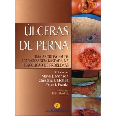 Imagem de Livro Prevenção E Tratamento De Úlceras De Pressão