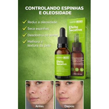 Imagem de Sérum Secativo Dermachem Anti Acne e Oleosidade Niacinamida