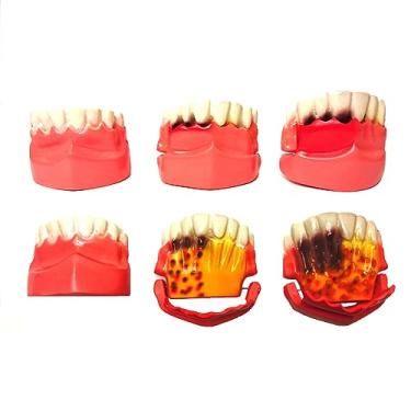 Imagem de MACRO MODELO EDUCATIVO DA EVOLUÇÃO DA DOENÇA PERIODONTAL