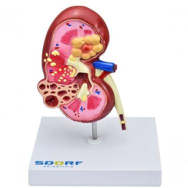 Imagem de Modelo Patológico Do Rim
