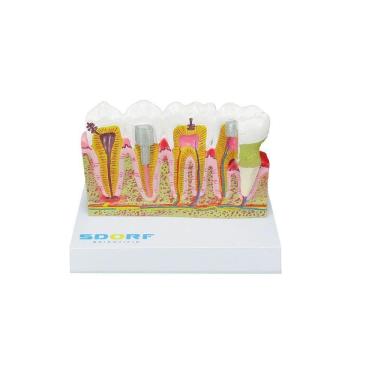 Imagem de Modelo de Patologias Dentárias SD-5202