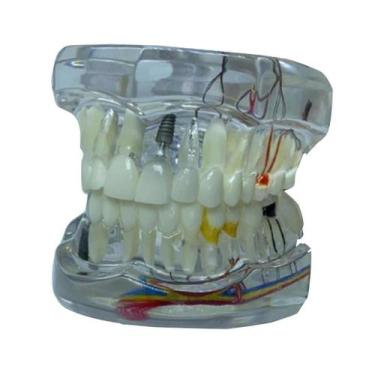Imagem de Macro Modelo Anatômico Odontológico Com Próteses E Implantes - D-Expre