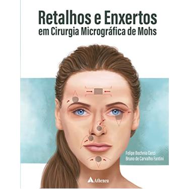 Imagem de Retalhos e Enxertos em Cirurgia Micrográfica de Mohs