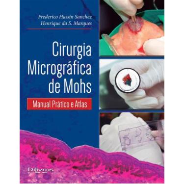 Imagem de CIRURGIA MICROGRAFICA DE MOHS, Autor: FREDERICO HASSIN SANCHEZ HENRIQU