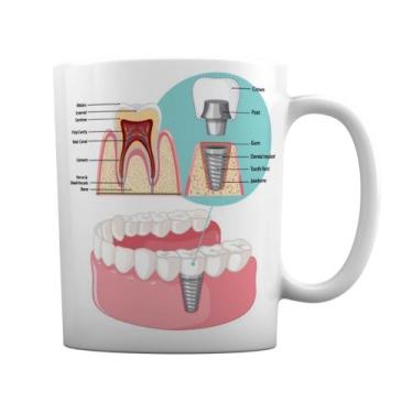 Imagem de Caneca Branca Dentista Prótese Dentária Implante Dentário - GMH
