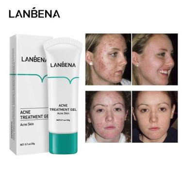 Imagem de Lanbena azul na acne gel la-122 - J-one