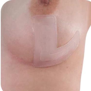 Imagem de Fita Silicone Cicatriz Queloide Mama Formato L - SiliSkin