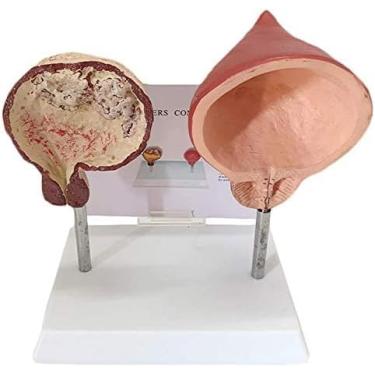 Imagem de Modelo De Comparação De Modelo De Bexiga Anatômica Médica De Bexiga Fumante E Bexiga Normal Modelo De Anatomia De órgãos Humanos Modelo Do Sistema Urinário Humano Para Ensino De Exibição De