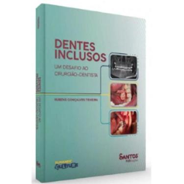 Imagem de Dentes Inclusos - Um Desafio ao Cirurgião-Dentista - Santos Publicaçõe