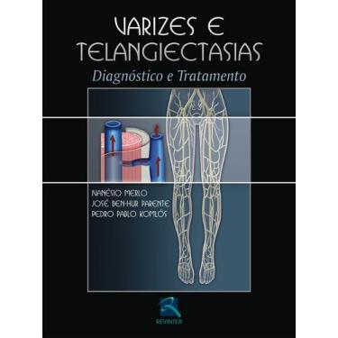 Imagem de Livro - Varizes e Telangiectasias