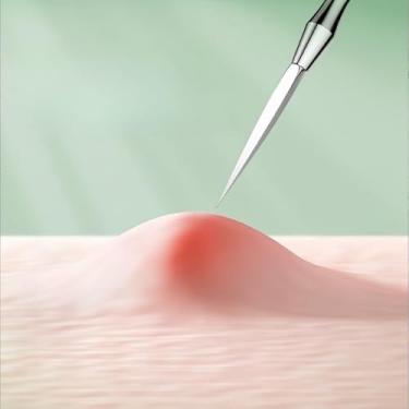 Imagem de Ferramenta profissional de limpeza facial, extrator de comedão de aço inoxidável para cuidados com a pele, dispositivo de precisão higiênico e fácil de limpar