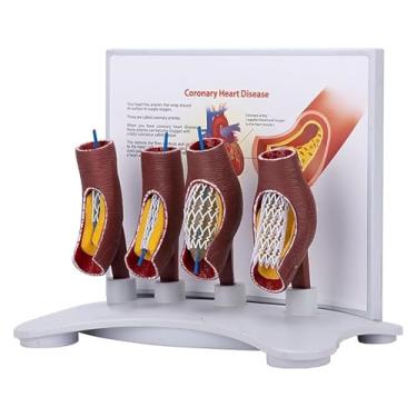 Imagem de Vascular Stent Model, Vascular Blockage Model, Human Coronary Stent Model, Human Vessel Enlargement Demonstration Teaching Aids, Vascular Anatomical Stent, for Medical Learning Display